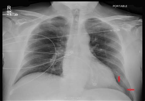Chest X Ray The Arrows Depict A Left Apical Bulge Download