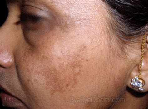 Melasma Treatment Pictures Causes Symptoms Cure