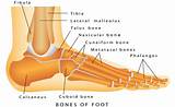 Broken Foot Bone On Side