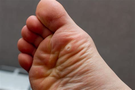 Treating Plantar Warts Finding Solutions That Work Instride Crystal