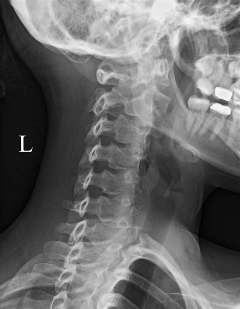 Normal Radiographic Anatomy Of The Cervical Spine La Unidad