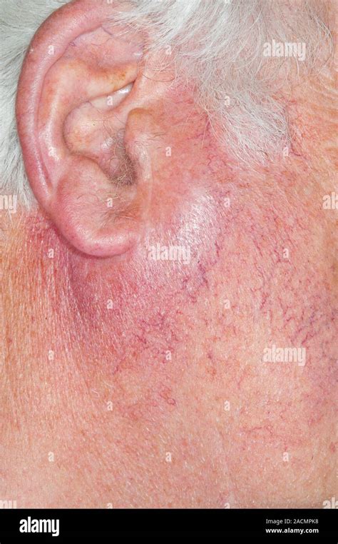 Swollen Parotid Salivary Gland Below The Ear In A 77 Year Old Male