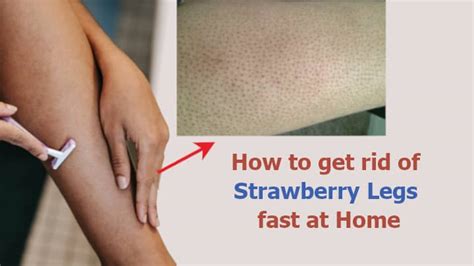 10 Easy Ways How To Get Rid Of Strawberry Legs Fast At Home
