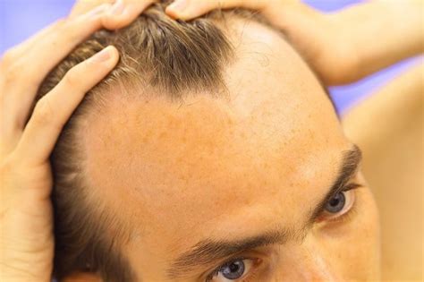 What Can Men Do About Balding