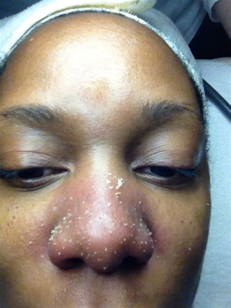 What to do if i have bright yellow water coming out of my nose? Think Your Milky, Dewy Skin Doesn't Need a Facial? Think ...