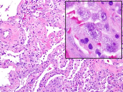 ALI W Hyaline Membranes 6 Patterns Of Pulmonary Pathology