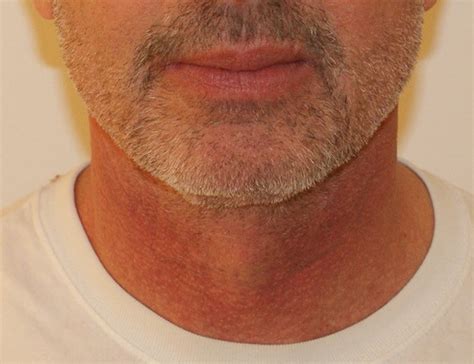 Short Scar Neck Lift Before And After 03 Dino Elyassnia Md