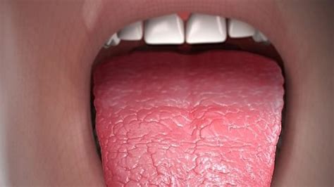 Xerostomia Dry Mouth Causes Symptoms And Treatment