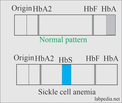 Anemia Part 5 A Sickle Cell Anemia And Sickle Cell Trait