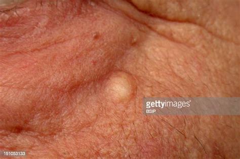 Sebaceous Cyst Photos And Premium High Res Pictures Getty Images