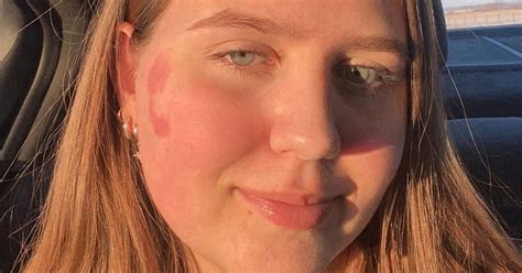 Teen Has Birthmark Of Twins Foot On Face After She Pressed Against Her