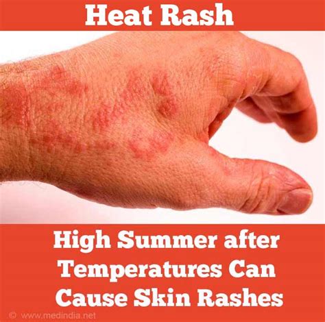 Summer Health Hazards