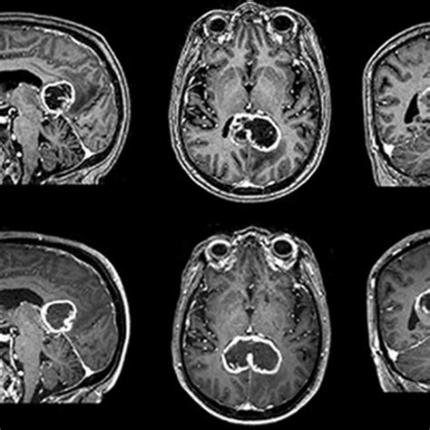 Abnormal Brain Mri Images