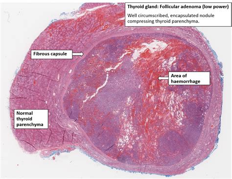 Thyroid Follicular Adenoma Nus Pathweb Nus Pathweb