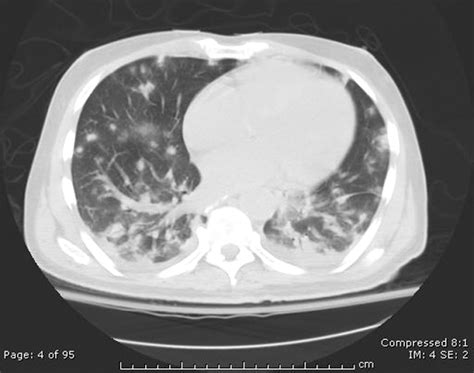 Bilateral Nodular Pulmonary Infiltrates In An Immunocompromised Host