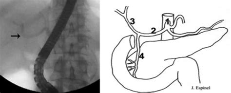 Ercp View Showing A Hepatic Artery Filling Arrow And A Schematic