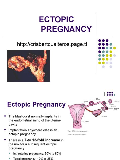 Ectopic Pregnancy5 Miscarriage Pregnancy
