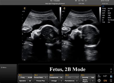 What Are The Differences Between 2d 3d And 4d Ultrasounds Scans