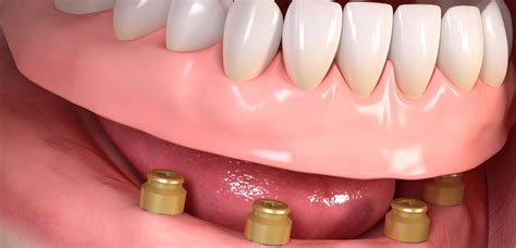 Implant Retained Dentures Mg Implants
