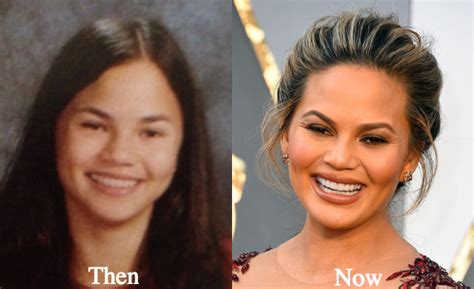 Chrissy Teigen Plastic Surgery Before And After Photos
