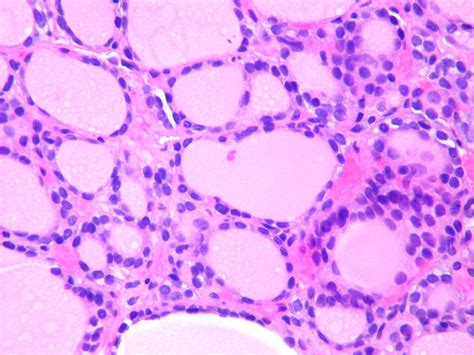 The thyroid glands are paired structures located along the windpipe (trachea), about halfway thyroid growths in your dog can be benign (adenoma) or malignant (carcinoma). Metastatic follicular thyroid carcinoma - Case 264 | Flickr