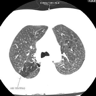 Small Airway Disease on Dynamic HRCT - Sumer's Radiology Blog