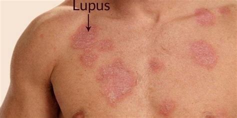 Lupus Rash Types Effects Diagnoses Treatments Prevent