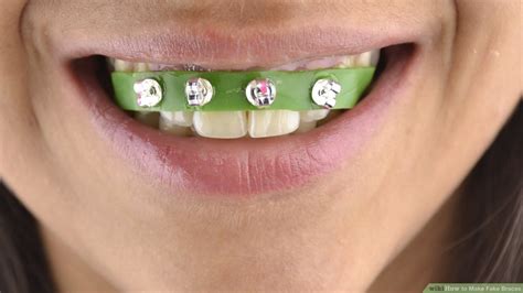 Diy Braces Kit How To Apply Dental Wax On Braces 12 Steps With Pictures An Alternative To