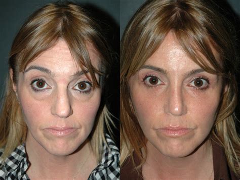 New york eyelid surgery specialist dr. Bowling Green KY eyelid surgery and non-surgical ...