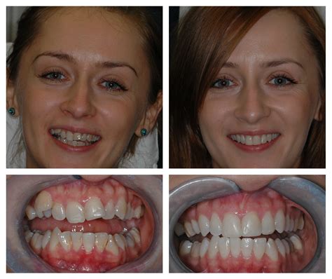 6 Month Smiles Braces Surrey Teeth Straightening Treatment