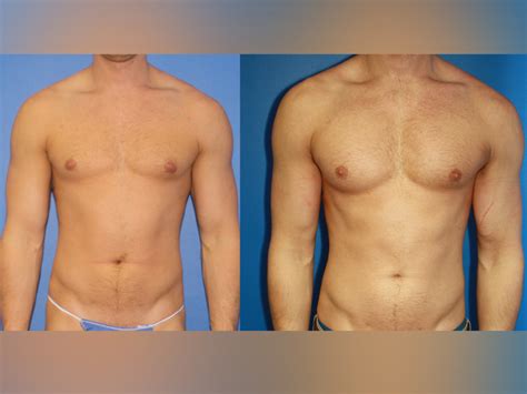 5 plastic surgeries that make fit guys look more muscular men s journal