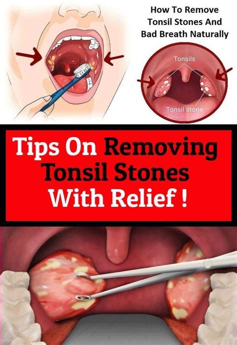 What Do Tonsils Look Like When Removed Kwhatdo