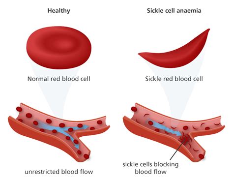 Multiple Myeloma Drug Could Revolutionize Treatment For Sickle Cell