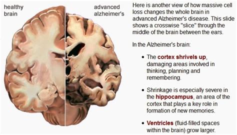 What can be done to reduce the risk of. Biology behind: Dementia. - Science in the City