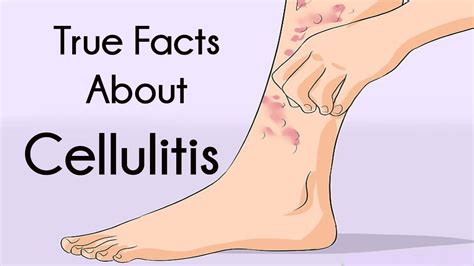 Cellulitis Symptoms