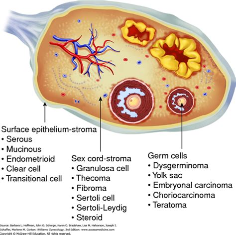 Ovarian Germ Cell And Sex Cord Stromal Tumors Williams Gynecology 3e Accessmedicine