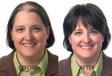 It is vitabiotic behind the perfectil. Womens Hair Transplant And Restoration For Her | Advanced ...
