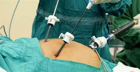A Complete Guide To Laparoscopic Gallbladder Surgery Latest
