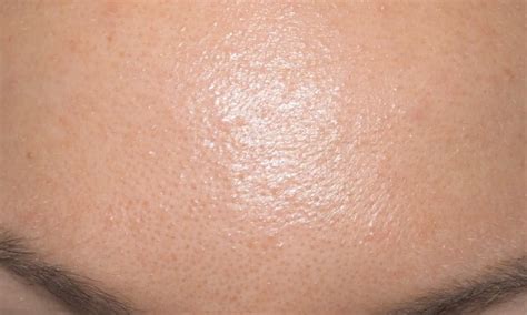 The skin may be affected by many problems such as blemishes, acne, dark spots, sebaceous filaments and others. Sebaceous filaments Archives - Charlotta Eve