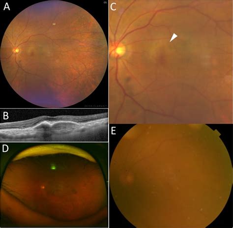 Fundus Photographs Of An Eye With Neovascular Amd Which Was Diagnosed