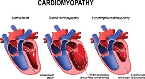 Binge Drinking And Heart Disease Rehab Guide