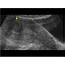 Gynaecology  31 Uterus Case 311 Uterine Fibroids Ultrasound Cases