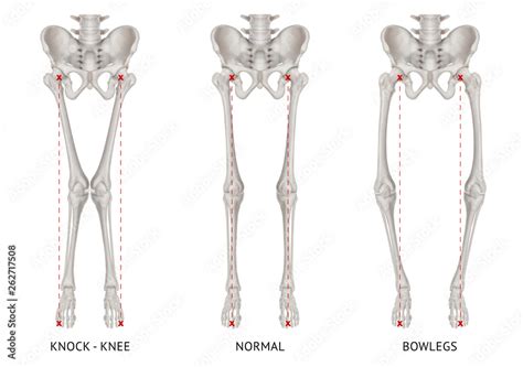 Alignment Types Disease Leg Bone Problem Of Knock Knee Normal And