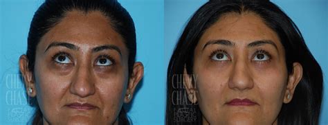 Patient 106387254 Blepharoplasty Before And After Photos Chevy Chase
