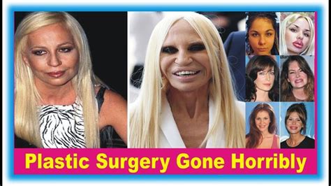 Plastic Surgery Gone Horribly Wrong Top 9 Worst Plastic Surgery