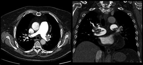 Values Of Thoracic Contrast‑enhanced Computed Tomography In Detecting