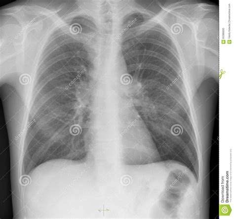 Normal Chest On X Ray Stock Photo Image 65386600