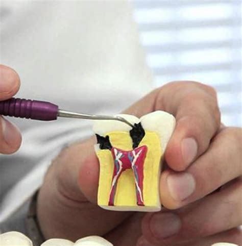 Endodontia Dr Sampaio Dentista