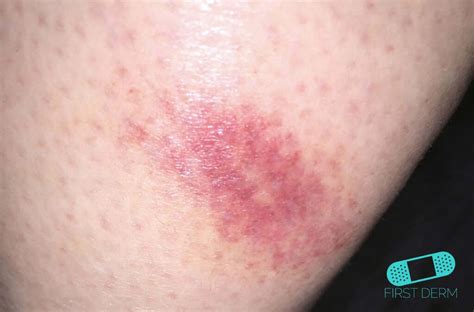 Insect Bite Online Dermatology