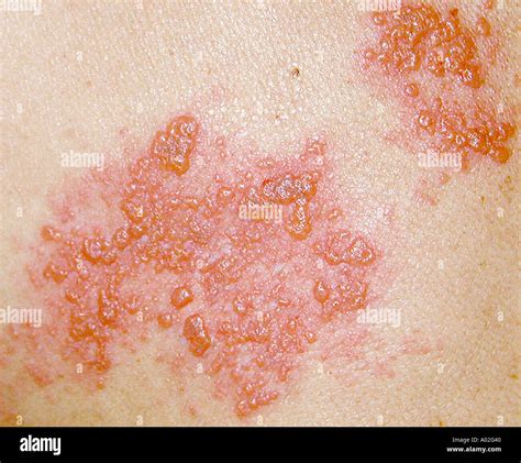 Herpes Zoster Gürtelrose Hautausschlag Stockfoto Bild 3217471 Alamy